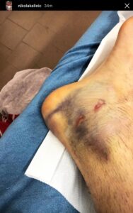 Kalinic, è tutto vero: ecco come è ridotta la sua caviglia - FOTO 29 Kalinic