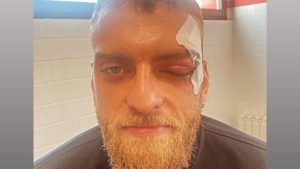 Di Gregorio ridotto male dopo Monza Milan: spunta la FOTO social dopo lo scontro in area